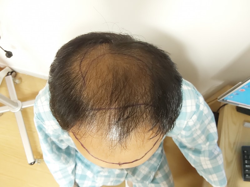 수술 전.jpg