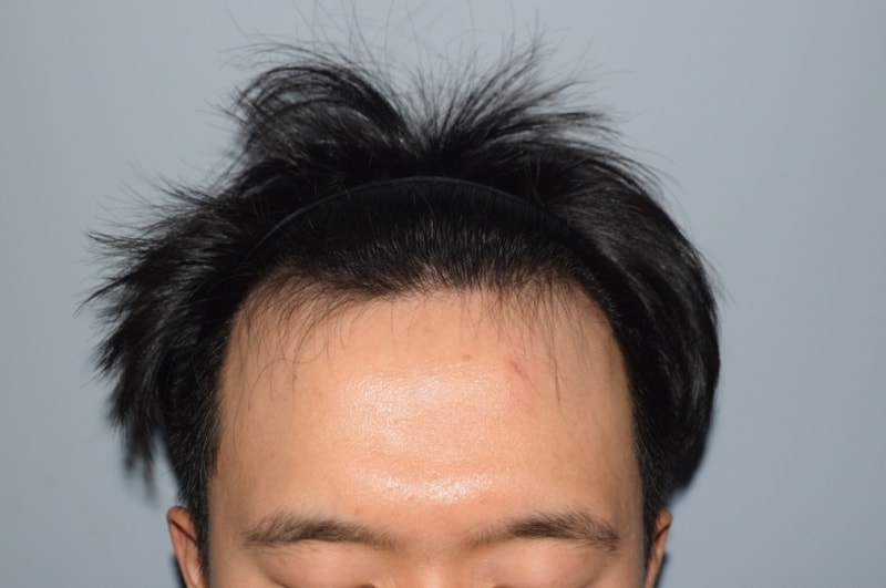 [다나]2900모 절개 9월26일 수술당일사진