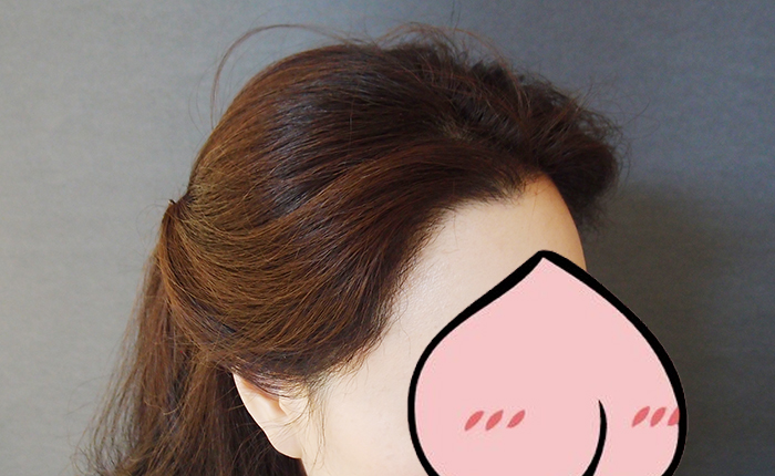 수술6개월1.jpg
