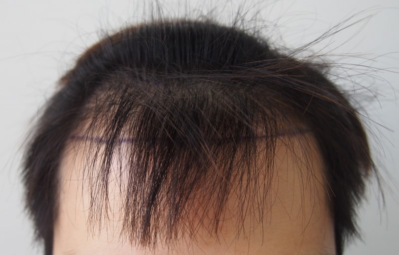 모재성 비절개 M자 1400 모낭