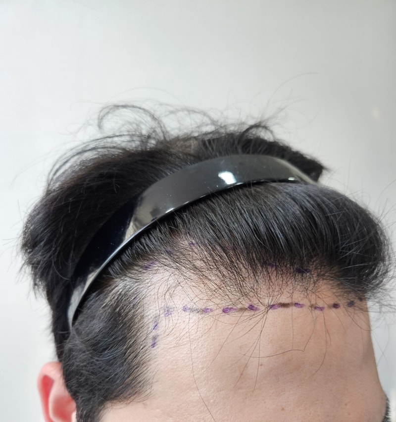240507_모발이식 견적 디자인3.jpg