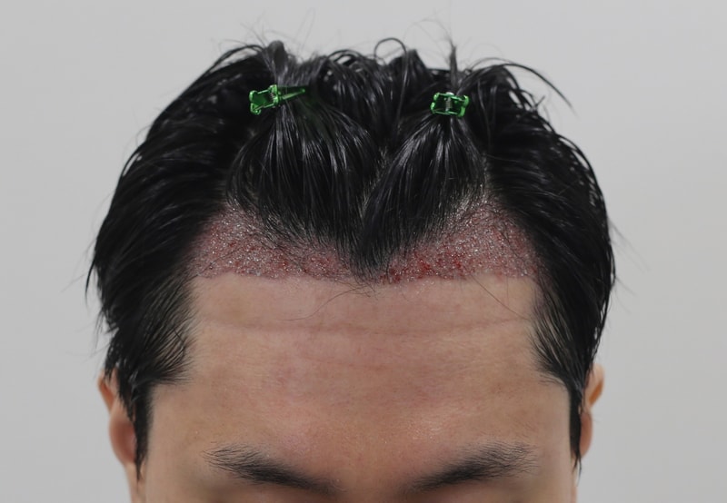 수술후.jpg