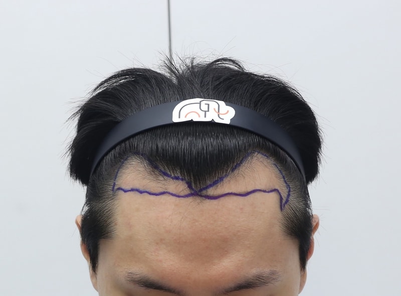 수술 전 디자인.jpg