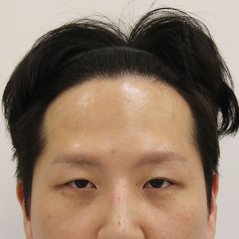 눈썹이식입니다