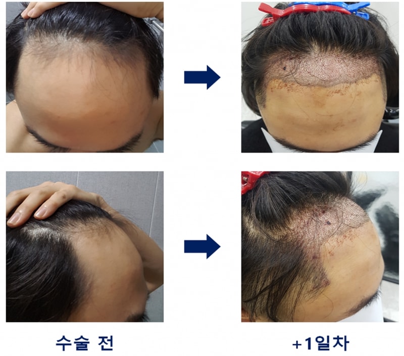 광주 압구정모비앙의원 비절개 3,400모 후기입니다.