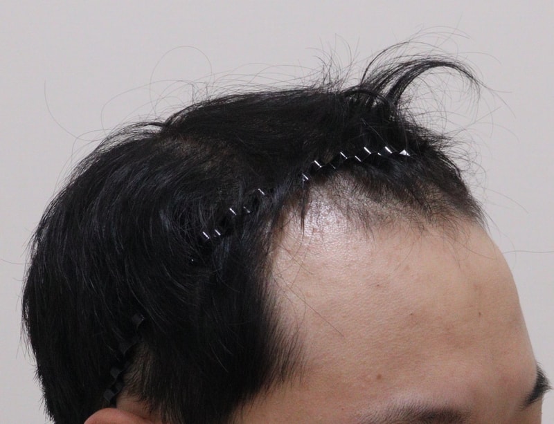 1. 수술전_4.JPG
