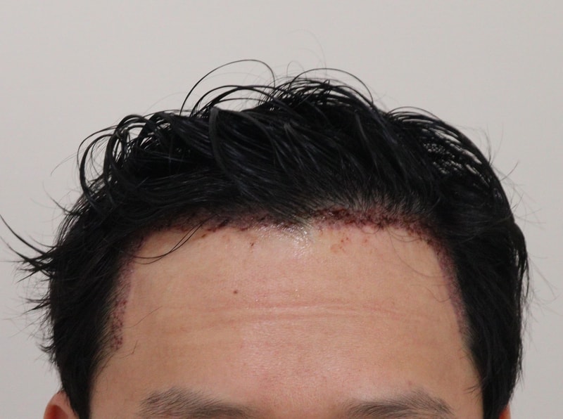 2. 수술후_1일_1.JPG