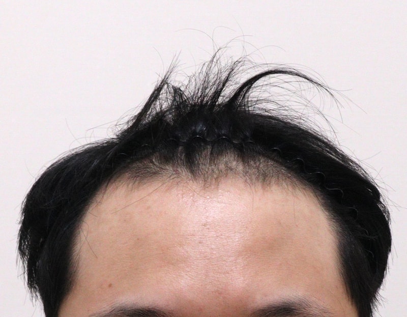 1. 수술전_1.JPG