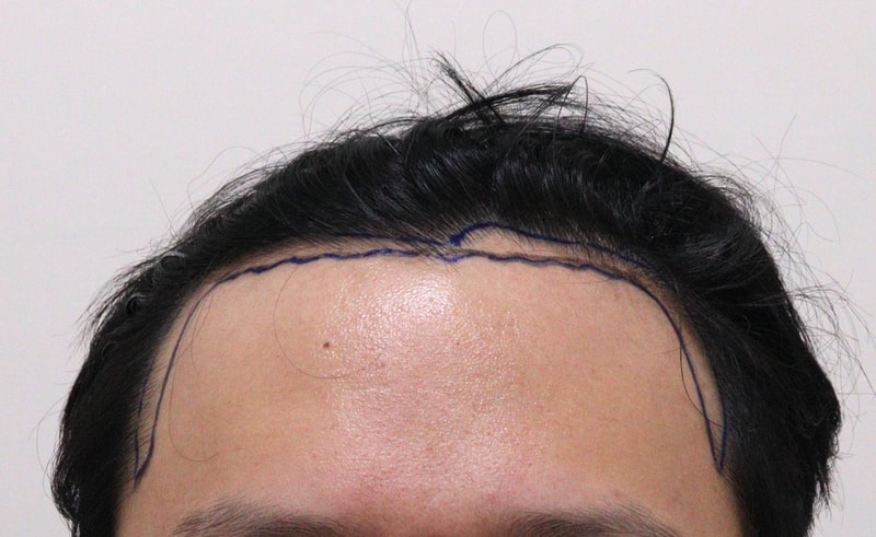 Transplanted 2800 non-cut hair! Please tell me how to take care of your skin!