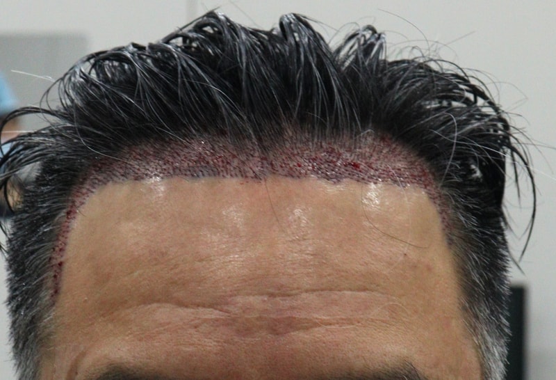 2. 수술후_당일_1.JPG