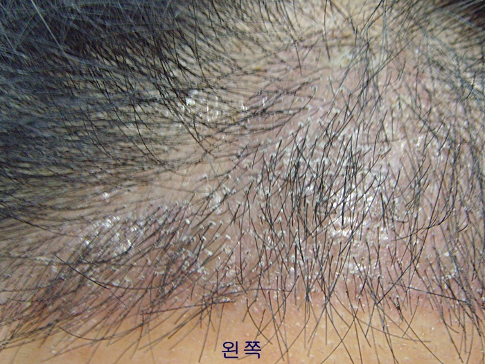 수술 2주째.JPG