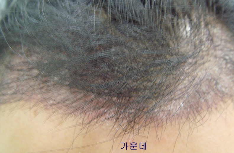 수술 2주째 (3).JPG