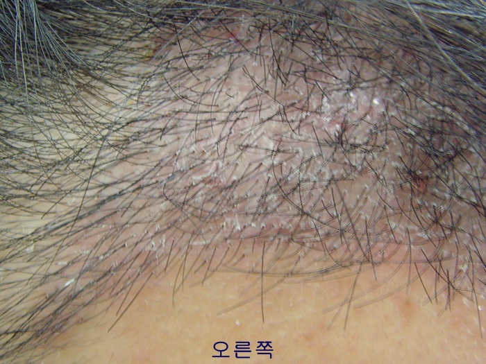 수술 2주째 (1).JPG