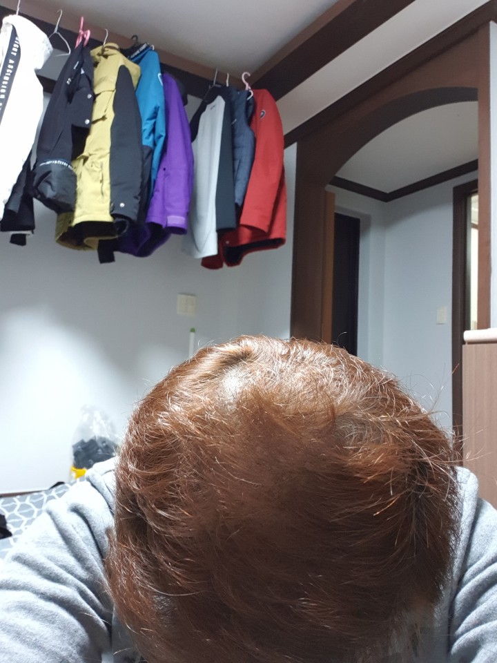 비절개 5000모  9개월 경과 포토후기입니다