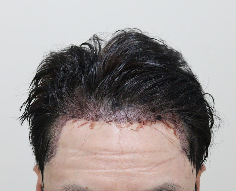 2. 수술후_1일_1.JPG