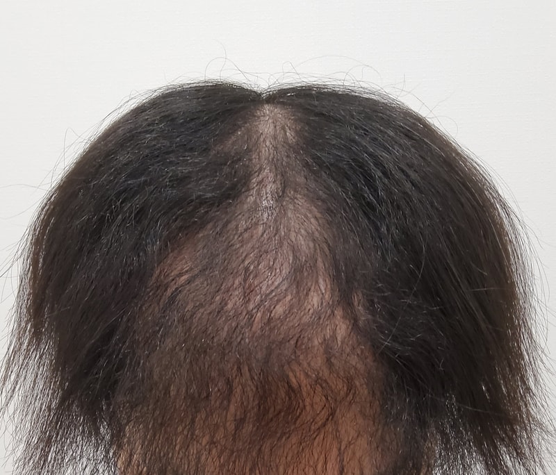 비절개 모발이식 재수술로 받고 3개월 됐습니다.