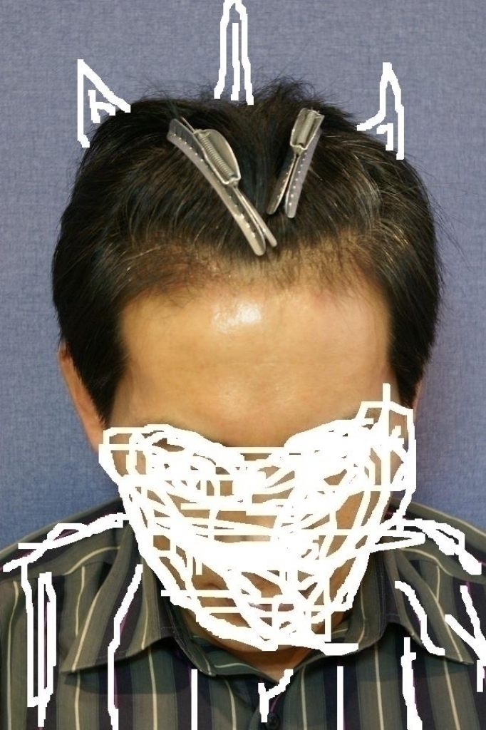 수술전편집.jpg