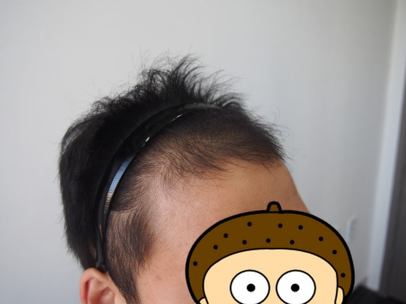 M자 1200모낭 4개월 차