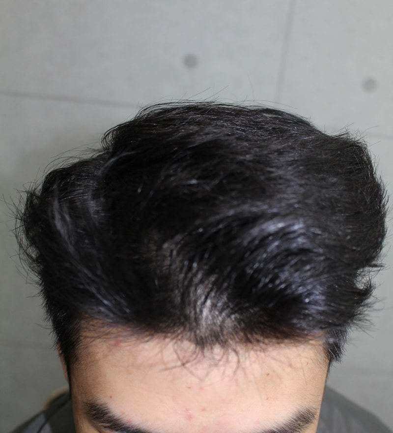 이식 후 정면.jpg