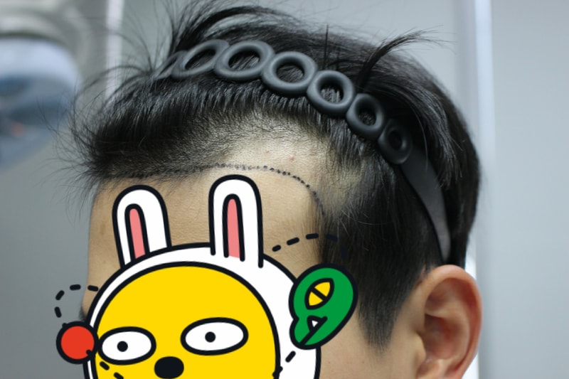 수술 전 왼.jpg