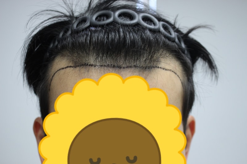 수술 전 정ㅁㄴ.jpg