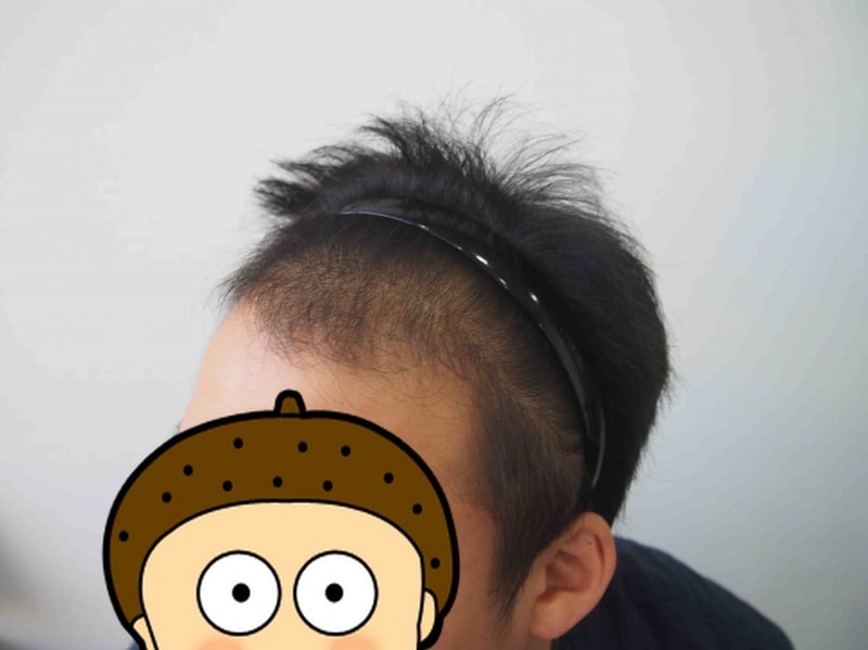 꾸미기_수술전 3.JPG