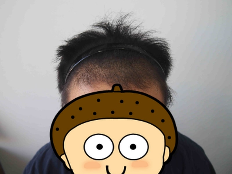 꾸미기_수술전 1.JPG