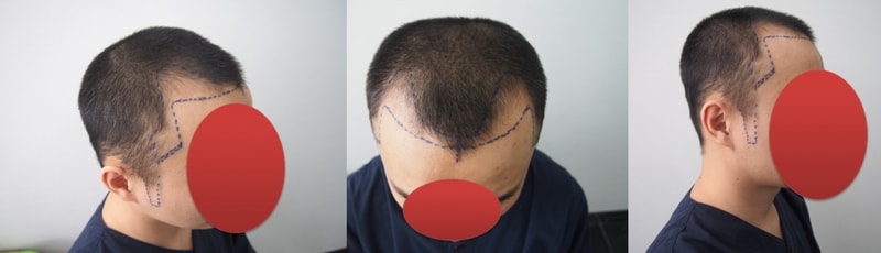 수술전 라인.PNG