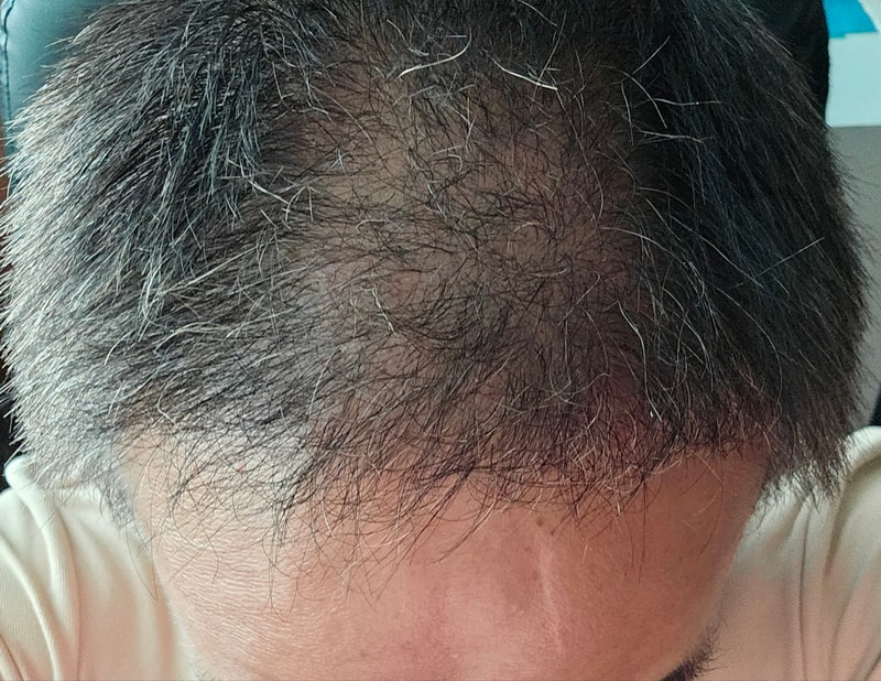 3. 수술후_3개월_셀카.jpg