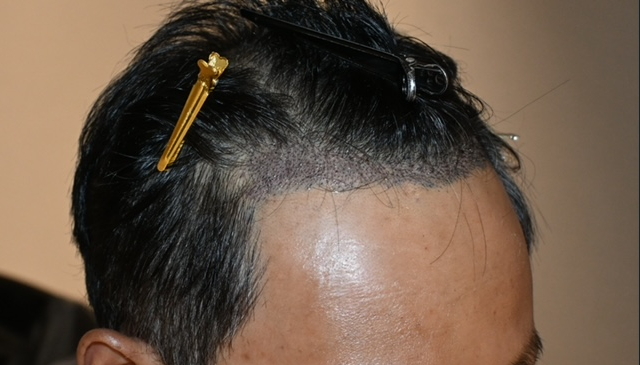 수술후 3일차1.JPG
