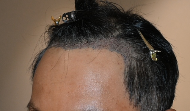 수술후 3일차2.JPG