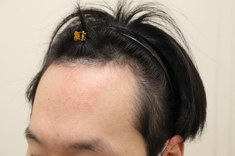 1. 수술전_2.JPG