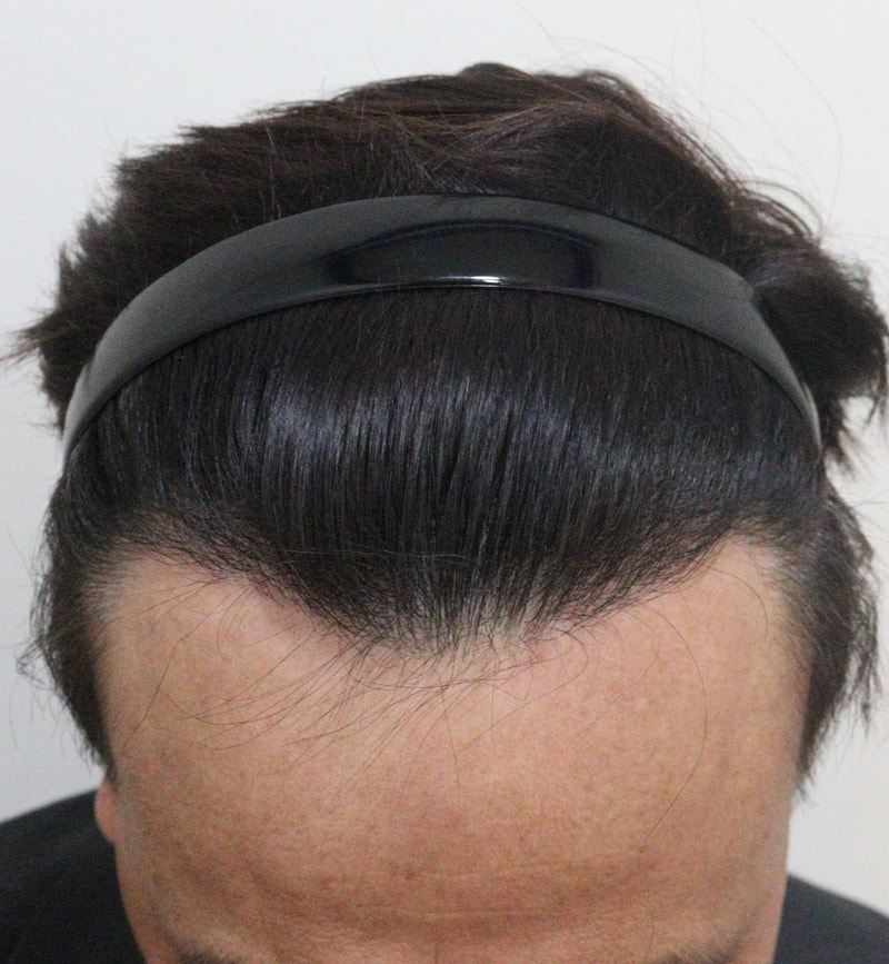 4. 수술후_1년_2.JPG