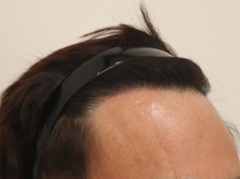 4. 수술후_1년_3.JPG