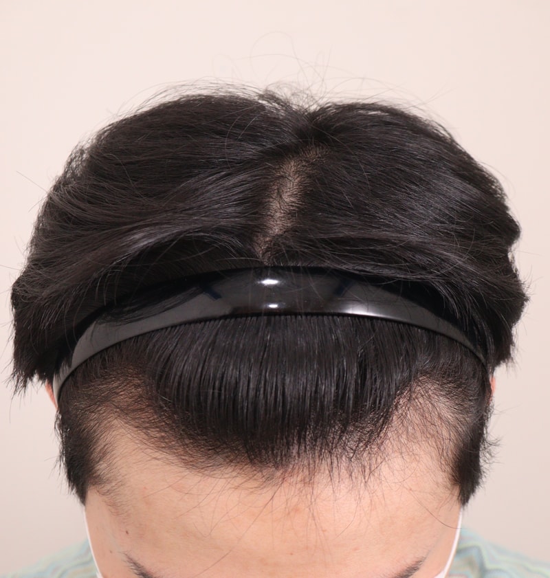 1. 수술전_2.JPG