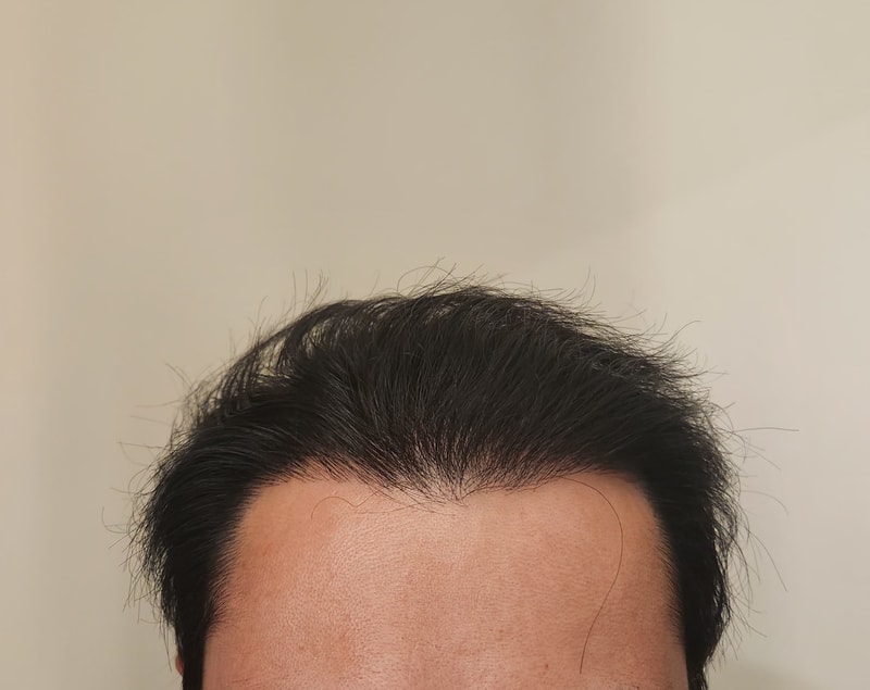 모발이식 1년후.jpg