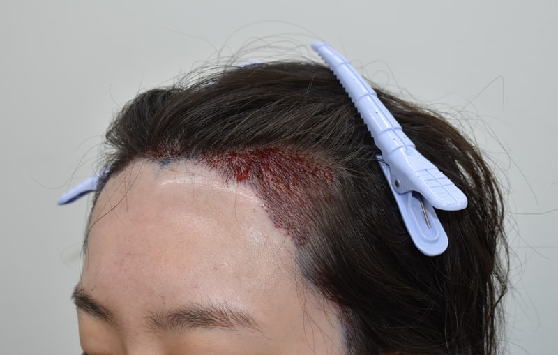 12540-2026김진아__수술후샴푸 (3).JPG