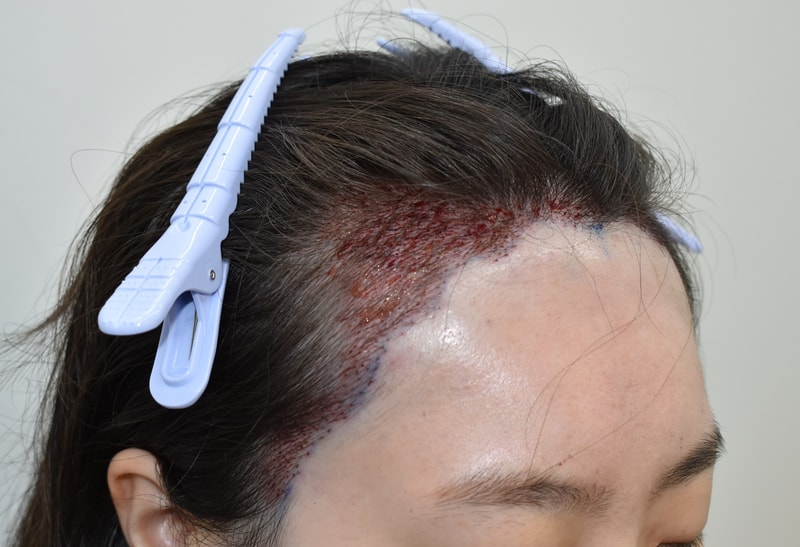 12540-2026김진아__수술후샴푸 (4).JPG