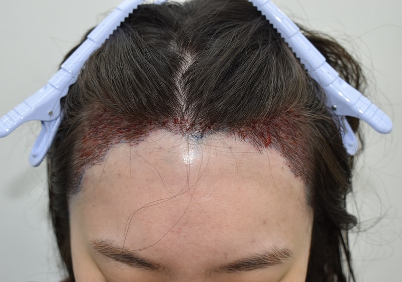 12540-2026김진아__수술후샴푸 (5).JPG