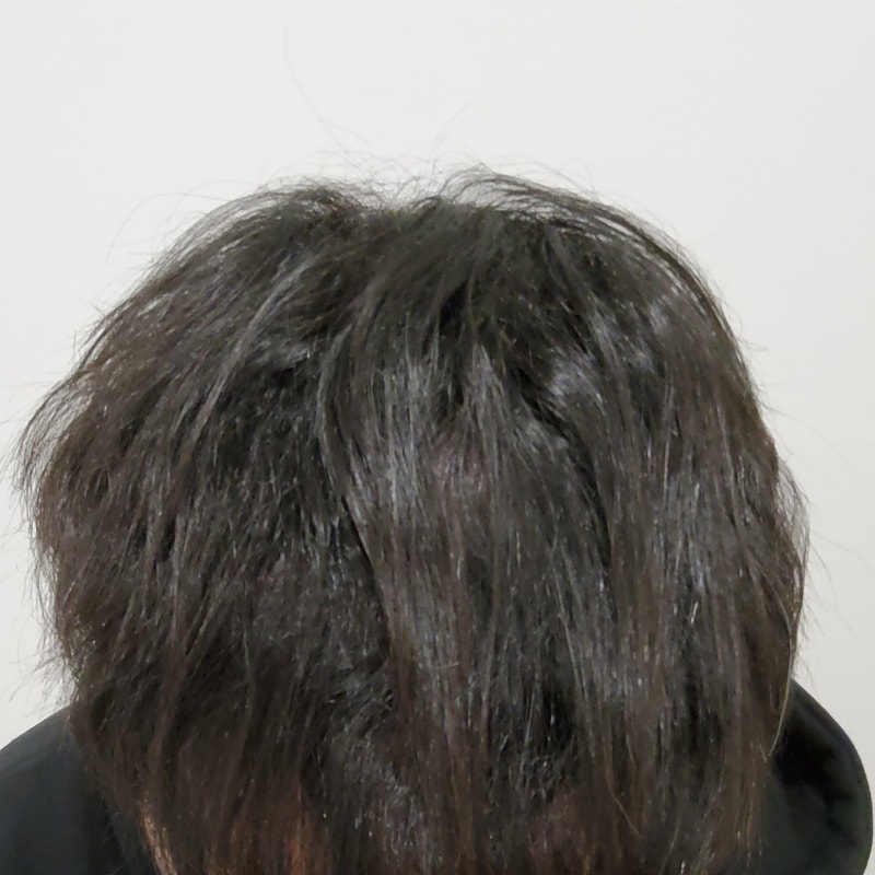 4. 수술후_1년_1.jpg