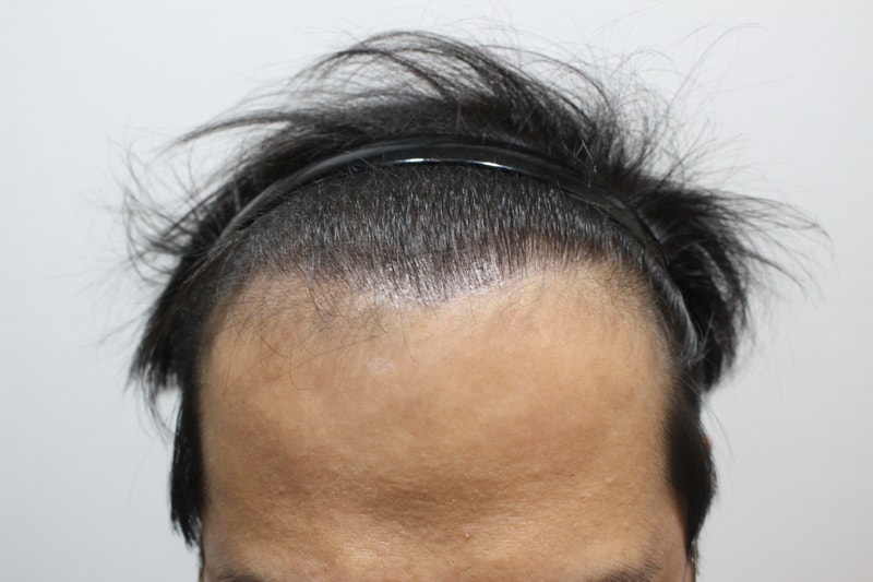 모발이식 후2.jpg