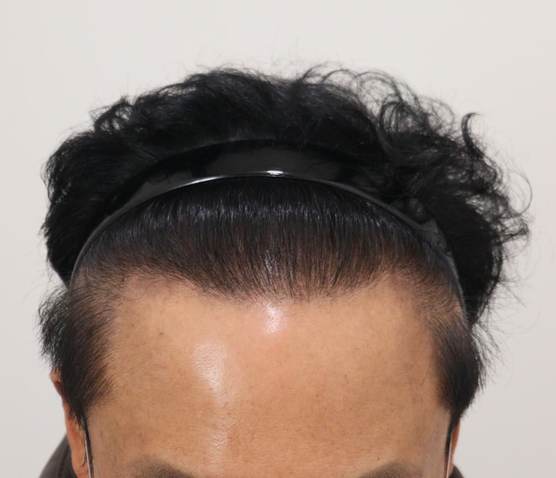 5. 수술후_1년_1.JPG