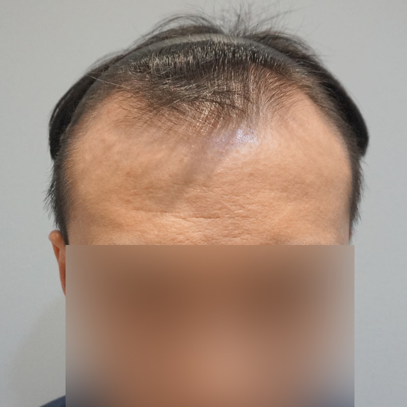 서진성형외과 M자 모발이식 비절개 5000모 1년 후기