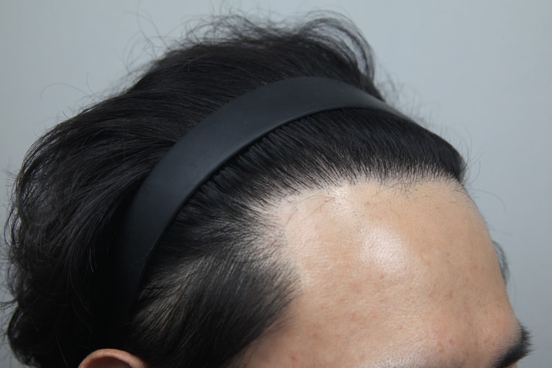 모나라모발이식1년 (5).jpg