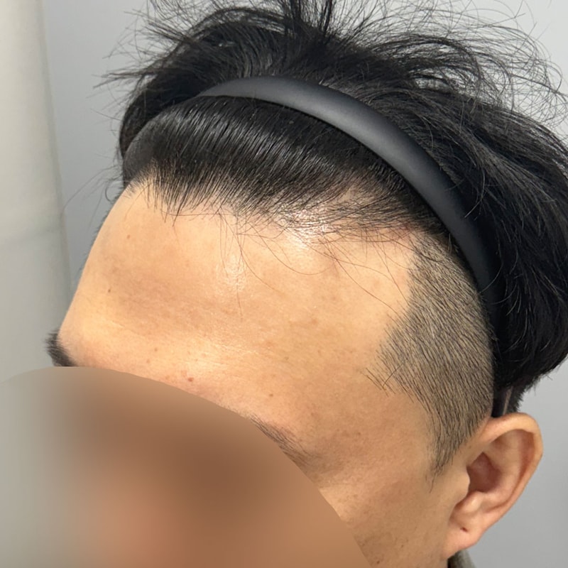 서진성형외과 M자 보강 및 헤어라인 교정 1년차 후기