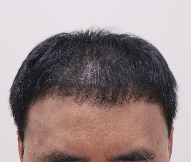 3. 수술후_6개월_1.JPG