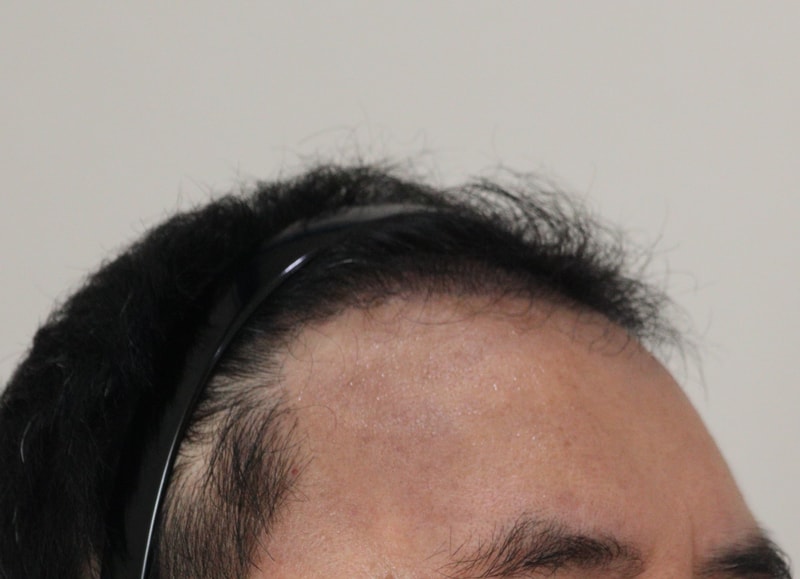 3. 수술후_6개월_3.JPG