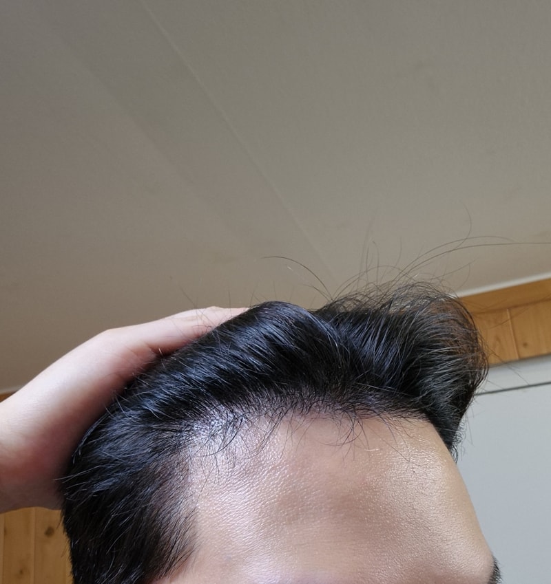 무삭발비절개쵝오3.jpg