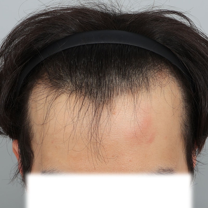 서진성형외과 M자+물결라인 헤어라인 4000모 이식 1년차