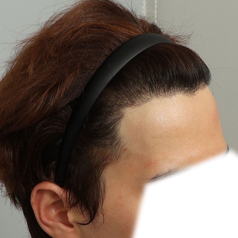 수술후#377D_2.jpg
